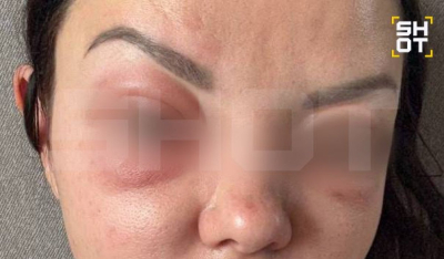 Укол от мешков под глазами привел к отекам и синякам
